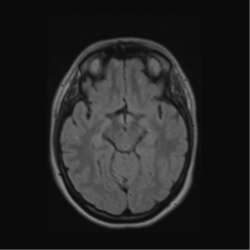 Acute disseminated encephalomyelitis (ADEM) (Radiopaedia 38073-40065 Axial FLAIR 25).png