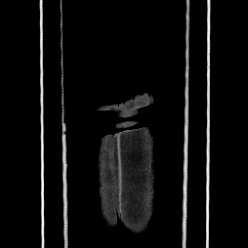 Acute diverticulitis - transverse colon (Radiopaedia 87063-103327 Coronal C+ portal venous phase 170).jpg