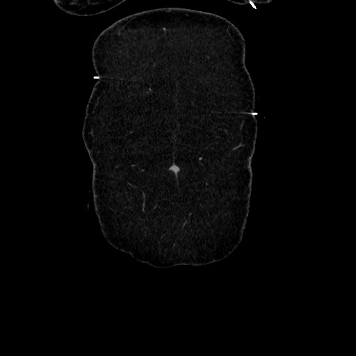 Acute diverticulitis - transverse colon (Radiopaedia 87063-103327 Coronal C+ portal venous phase 25).jpg