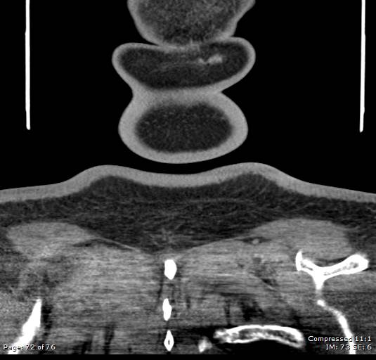 Acute epiglottitis (Radiopaedia 54375-60590 Coronal C+ arterial phase 72).jpg