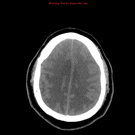 Acute hemorrhagic leukoencephalitis (Radiopaedia 14076-13920 Axial non-contrast 37).jpg