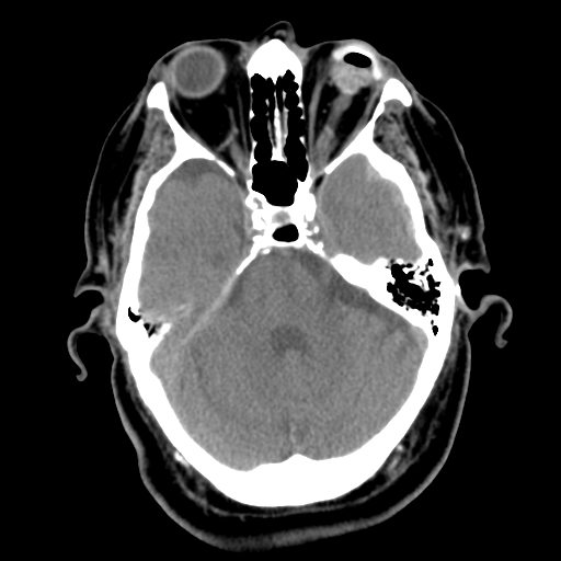 Acute hemorrhagic stroke (Radiopaedia 17507-17223 Axial non-contrast 16).jpg