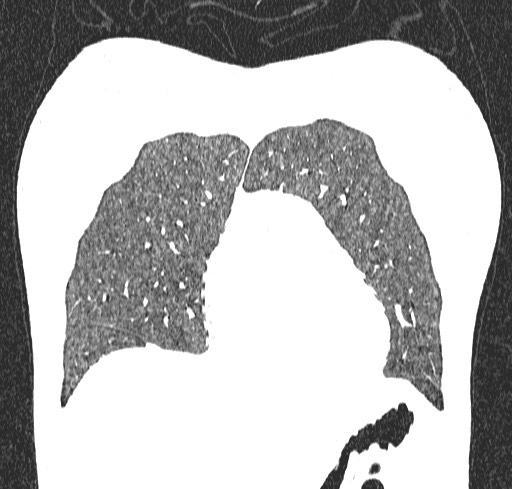 Acute hypersensitivity pneumonitis (Radiopaedia 85293-100870 Coronal lung window 23).jpg