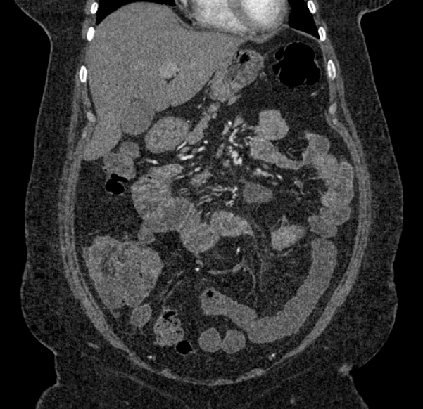 Acute mesenteric ischemia (Radiopaedia 80029-93316 Coronal C+ arterial phase 42).jpg
