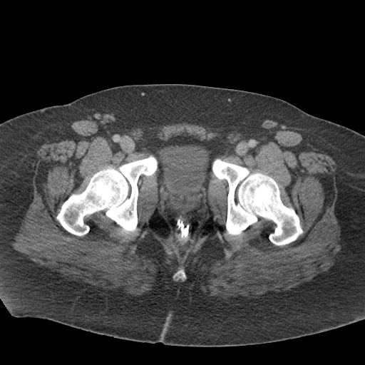 Acute mesenteric venous ischemia (Radiopaedia 46041-50383 Axial C+ portal venous phase 140).jpg