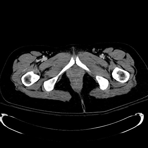 Acute myocardial infarction in CT (Radiopaedia 39947-42415 Axial C+ portal venous phase 144).jpg