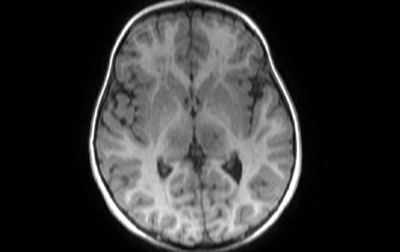 File:Acute necrotizing encephalitis of childhood (Radiopaedia 67356-76737 Axial T1 47).jpg