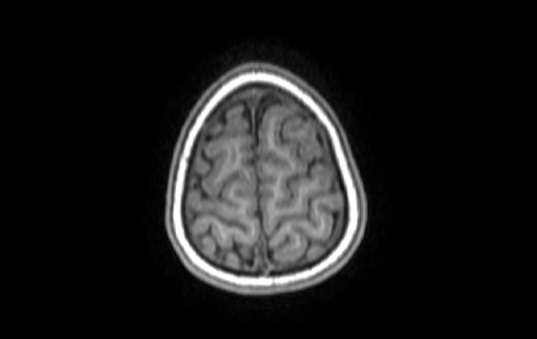 File:Acute necrotizing encephalitis of childhood (Radiopaedia 67356-76737 Axial T1 9).jpg