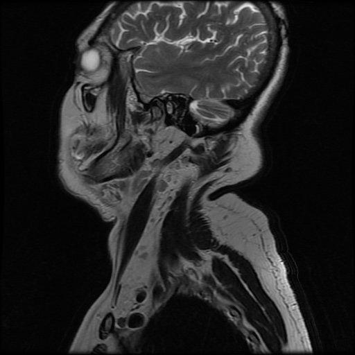 File:Acute otitis externa (Radiopaedia 57296-64236 Sagittal T2 8).jpg