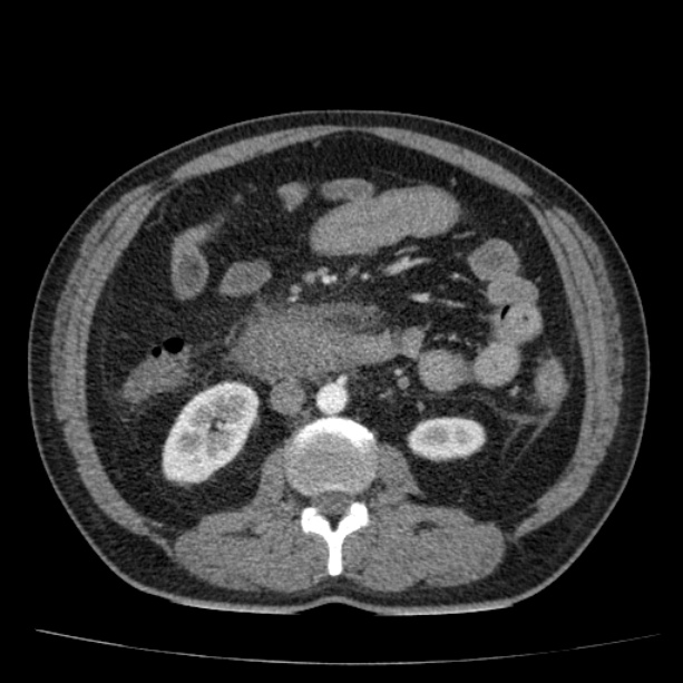 Acute pancreatitis (Radiopaedia 26663-26813 Axial C+ arterial phase 51).jpg