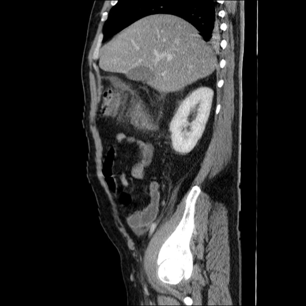 Acute pancreatitis (Radiopaedia 26663-26813 Sagittal C+ portal venous phase 21).jpg