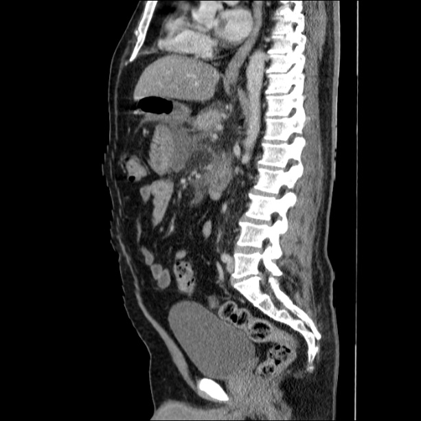 Acute pancreatitis (Radiopaedia 26663-26813 Sagittal C+ portal venous phase 41).jpg