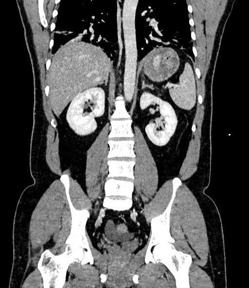 Acute pancreatitis (Radiopaedia 87428-103757 Coronal C+ portal venous phase 61).jpg