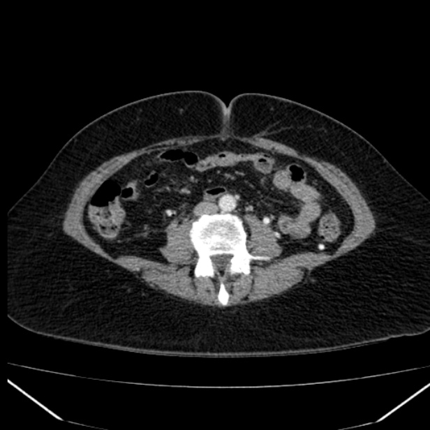 Acute pancreatitis - Balthazar C (Radiopaedia 26569-26714 Axial C+ arterial phase 55).jpg