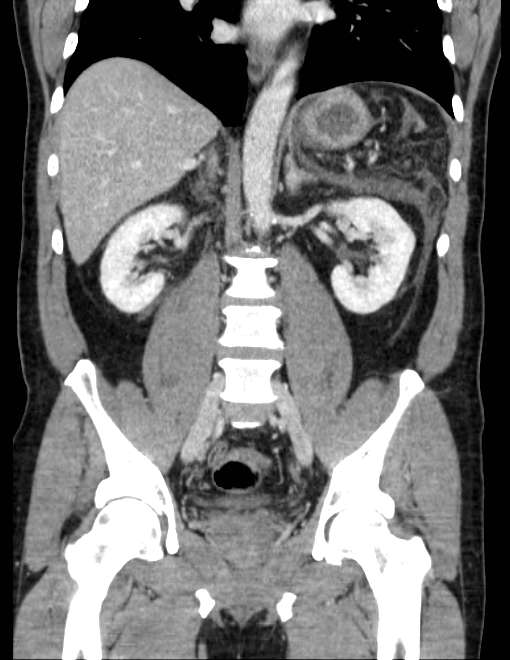 Acute pancreatitis - Balthazar E (Radiopaedia 23080-23110 Coronal C+ portal venous phase 49).jpg