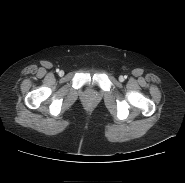 File:Acute pancreatitis - Balthazar E (Radiopaedia 29016-29377 Axial C+ portal venous phase 75).png