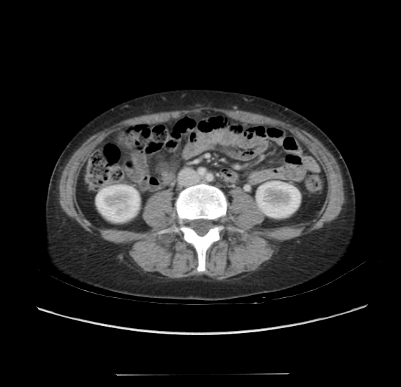 Acute pancreatitis - Balthazar E - post ERCP (Radiopaedia 27562-27772 Axial C+ portal venous phase 43).png
