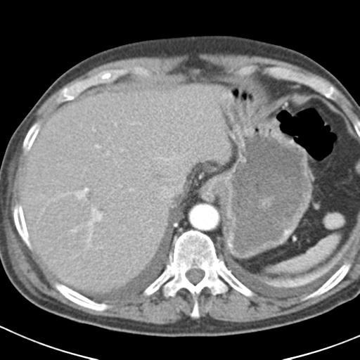 File:Acute pancreatitis and walled-off necrosis (Radiopaedia 29888-30403 Axial C+ portal venous phase 2).jpg