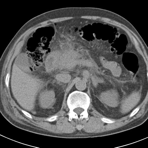 File:Acute pancreatitis and walled-off necrosis (Radiopaedia 29888-30403 Axial non-contrast 22).jpg