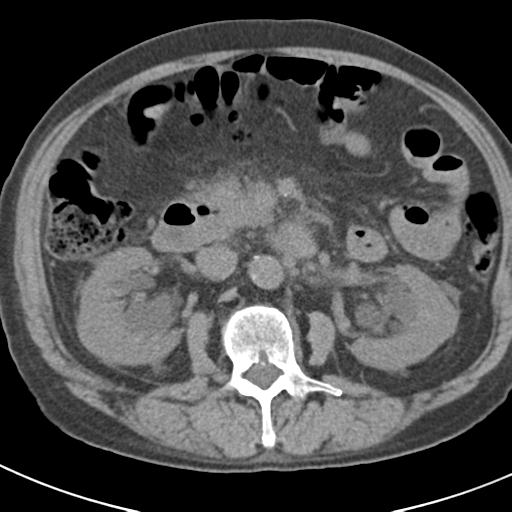 File:Acute pancreatitis and walled-off necrosis (Radiopaedia 29888-30403 Axial non-contrast 31).jpg