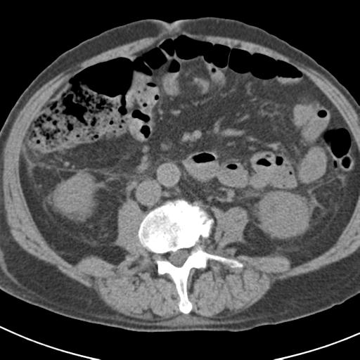 File:Acute pancreatitis and walled-off necrosis (Radiopaedia 29888-30403 Axial non-contrast 39).jpg