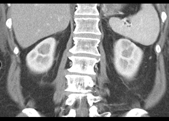 Acute pancreatitis and walled-off necrosis (Radiopaedia 29888-30403 Coronal C+ portal venous phase 42).jpg