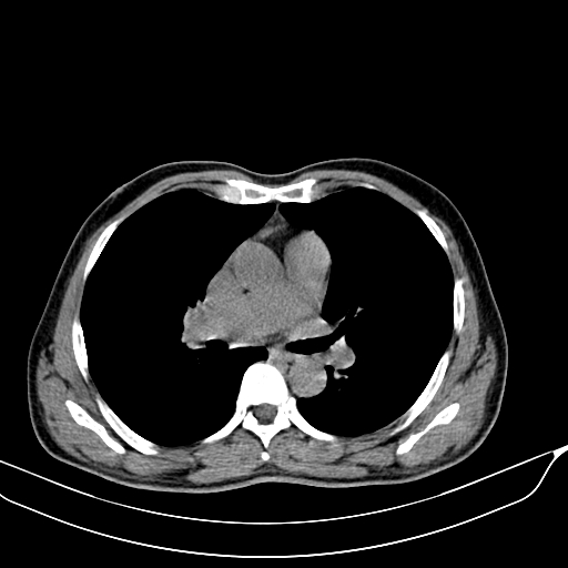 File:Acute pulmonary embolism (Radiopaedia 69510-79390 Axial non-contrast 11).jpg