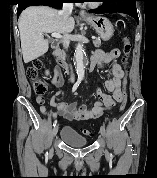 Acute renal infarction (Radiopaedia 59375-66736 Coronal C+ portal venous phase 29).jpg