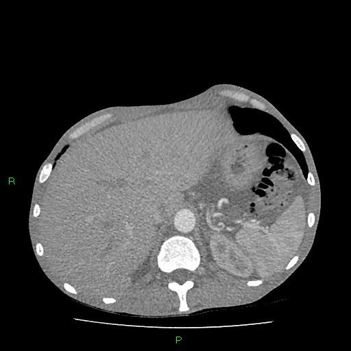File:Acute right lung abscess (Radiopaedia 34806-36258 Axial C+ arterial phase 178).jpg