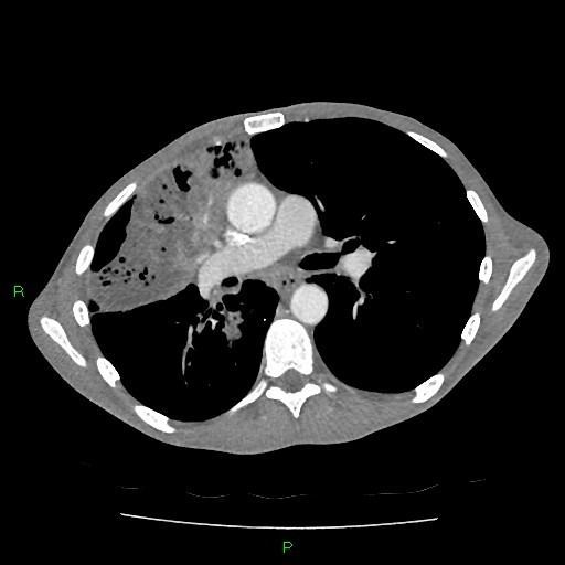 File:Acute right lung abscess (Radiopaedia 34806-36258 Axial C+ arterial phase 86).jpg