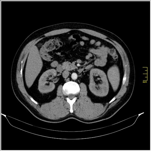 File:Acute right sided diverticulitis (Radiopaedia 65249-74268 Axial C+ portal venous phase 31).JPG