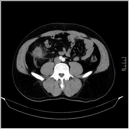 Acute right sided diverticulitis (Radiopaedia 65249-74268 Axial C+ portal venous phase 47).JPG