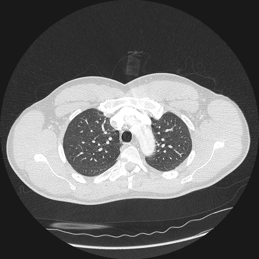 Acute segmental pulmonary emboli and pulmonary infarction (Radiopaedia 62264-70444 Axial lung window 45).jpg