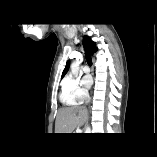File:Acute segmental pulmonary emboli and pulmonary infarction (Radiopaedia 62264-70444 Sagittal C+ CTPA 33).jpg