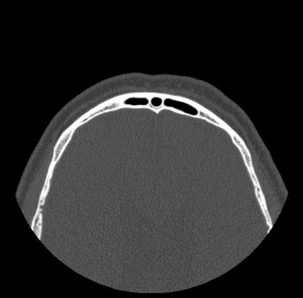 Acute sinusitis (Radiopaedia 23161-23215 Axial bone window 78).jpg