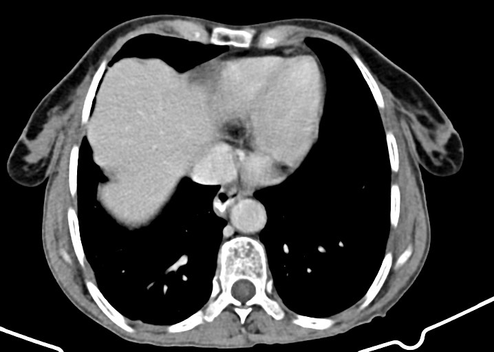Acute small bowel (ileal) volvulus (Radiopaedia 71740-82139 Axial C+ portal venous phase 35).jpg