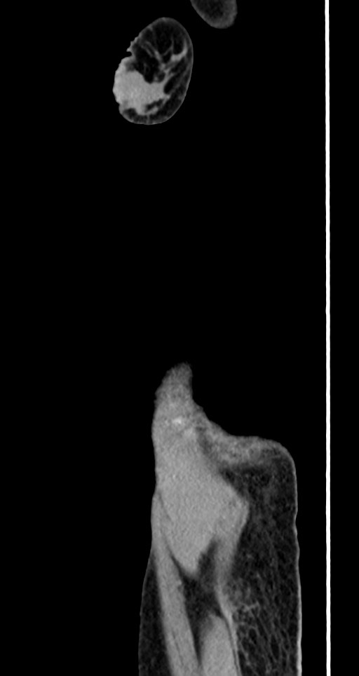 Acute small bowel (ileal) volvulus (Radiopaedia 71740-82139 Sagittal C+ portal venous phase 16).jpg