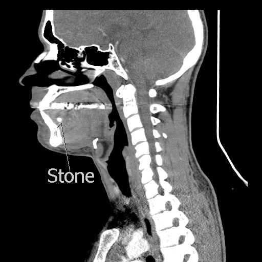 File:Acute submandibular sialadenitis secondary to ductal stone (Radiopaedia 27999-28267 Sagittal C+ delayed 2).jpg