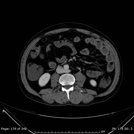 Acute superior mesenteric artery occlusion (Radiopaedia 43636-47060 Axial C+ portal venous phase 26).jpg