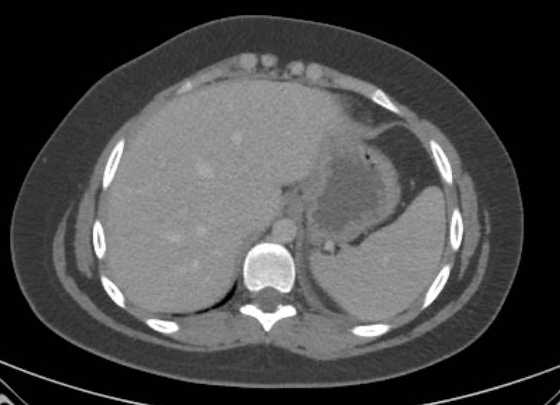 Acute unilateral nonhemorrhagic adrenal infarction (Radiopaedia 67560-76957 Axial renal parenchymal phase 3).jpg