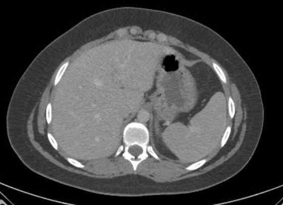 Acute unilateral nonhemorrhagic adrenal infarction (Radiopaedia 67560-76957 Axial renal parenchymal phase 8).jpg