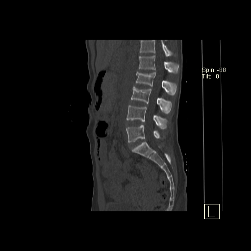 File:Acute vertebral compression fracture (Radiopaedia 63832-72559 Sagittal bone window 10).jpg