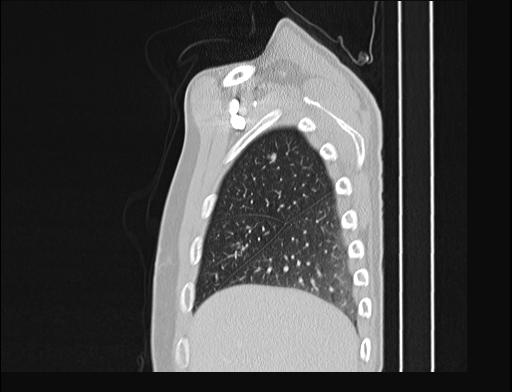 Addison disease (Radiopaedia 49318-54412 Sagittal lung window 54).jpg