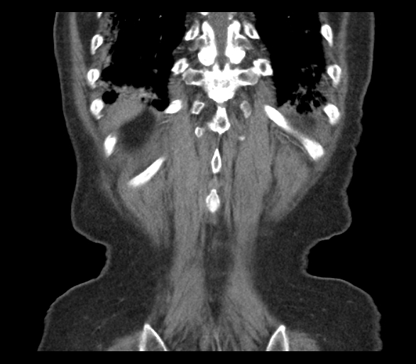 Adenocarcinoma of cecum (Radiopaedia 59222-66549 Coronal C+ arterial phase 67).jpg