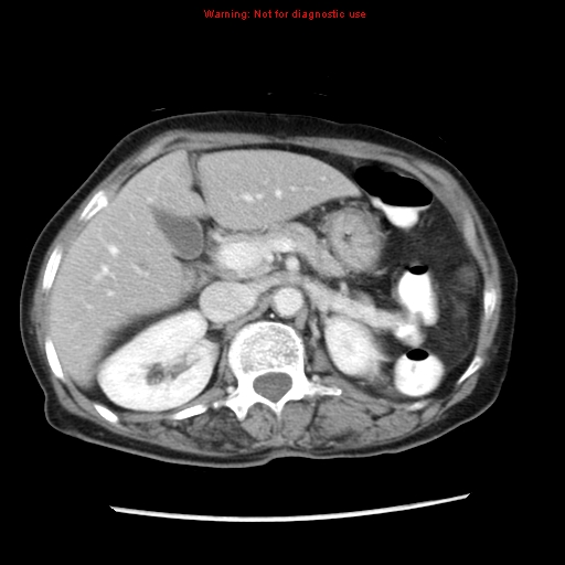 File:Adenocarcinoma of the colon (Radiopaedia 8191-9039 Axial liver window 25).jpg