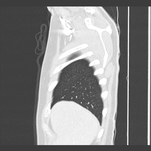 Adenocarcinoma of the lung (Radiopaedia 59871-67325 Sagittal lung window 9).jpg