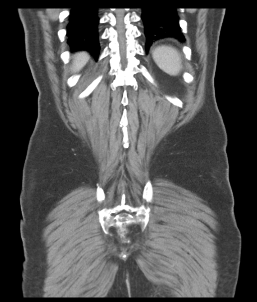 Adenocarcioma of rectum- T1 lesion (Radiopaedia 36921-38547 Coronal C+ portal venous phase 54).png