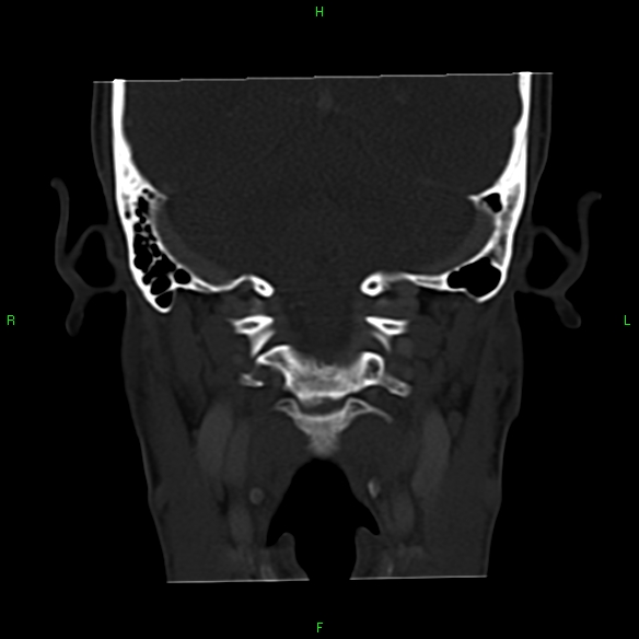 File:Adenoid cystic carcinoma of hard palate (Radiopaedia 26137-26273 Coronal bone window 28).jpg
