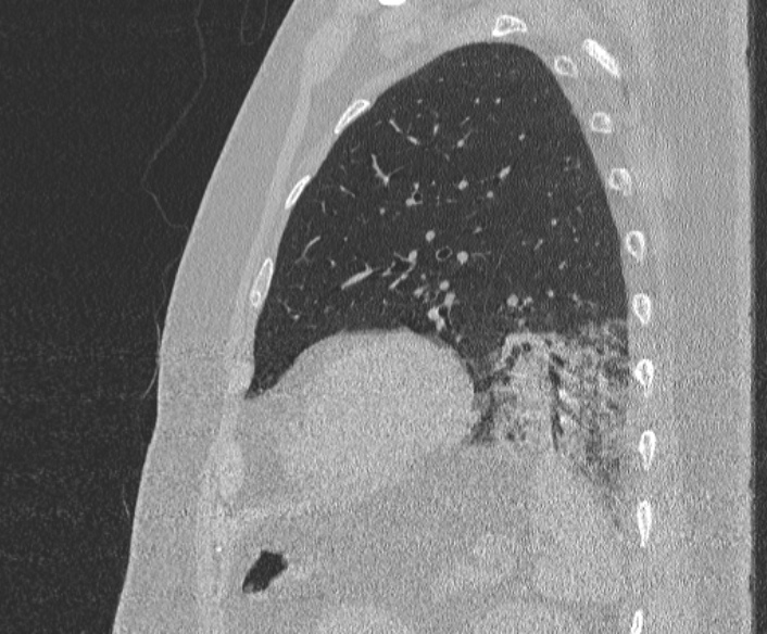 Adenoid cystic carcinoma of the trachea (Radiopaedia 49042-54137 Sagittal lung window 351).jpg