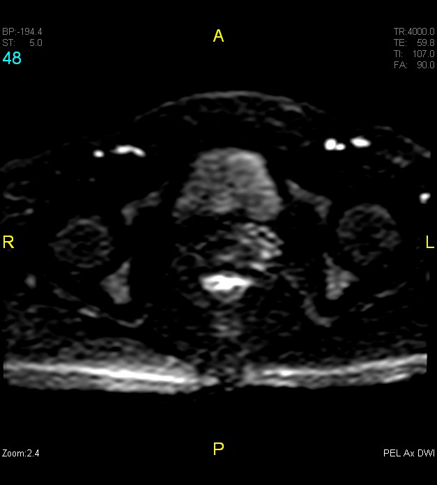 Adenomyosis (Radiopaedia 43504-46889 Axial DWI 48).jpg